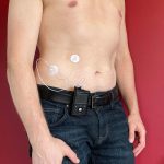 A man wearing glucose sensors and an insulin pump