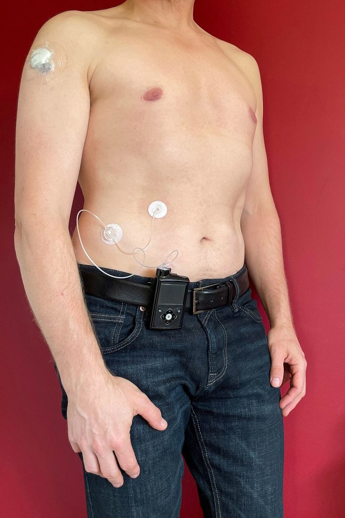 A man wearing glucose sensors and an insulin pump